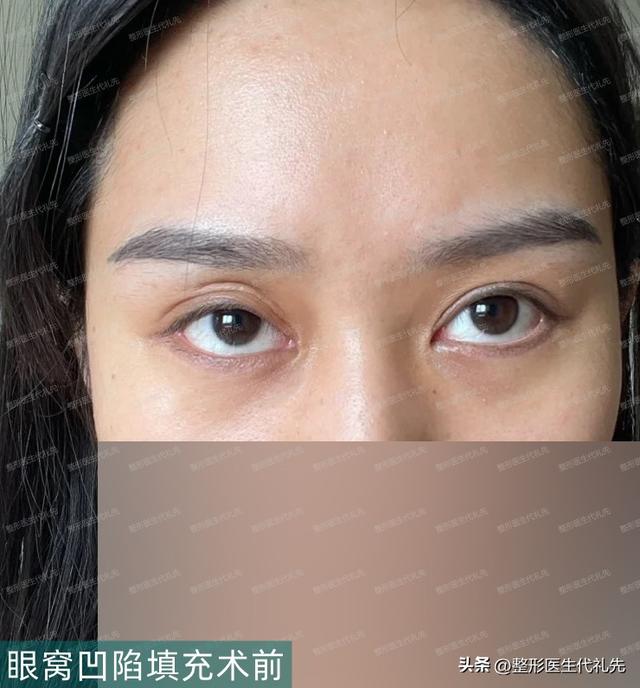 眼窝凹陷怎么填充的过程（关于眼窝凹陷填充你想要了解的都在这里）(5)